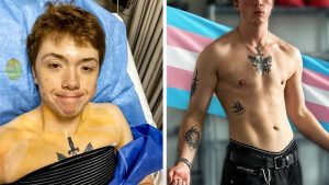 FTM top surgery